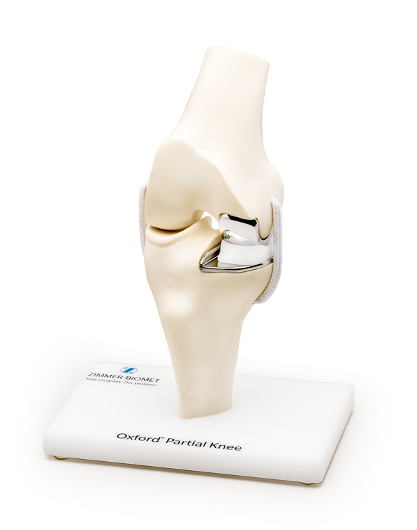 New Advancements in Knee Surgery Offer Options to Stop